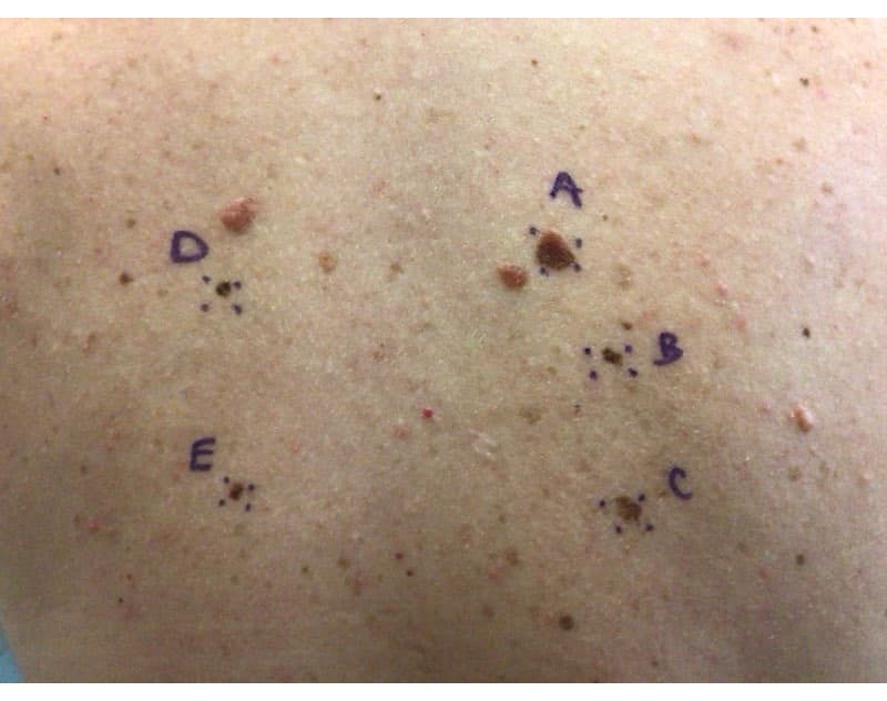 Can you pick out the melanoma mole on Madison's back? (It is "A")